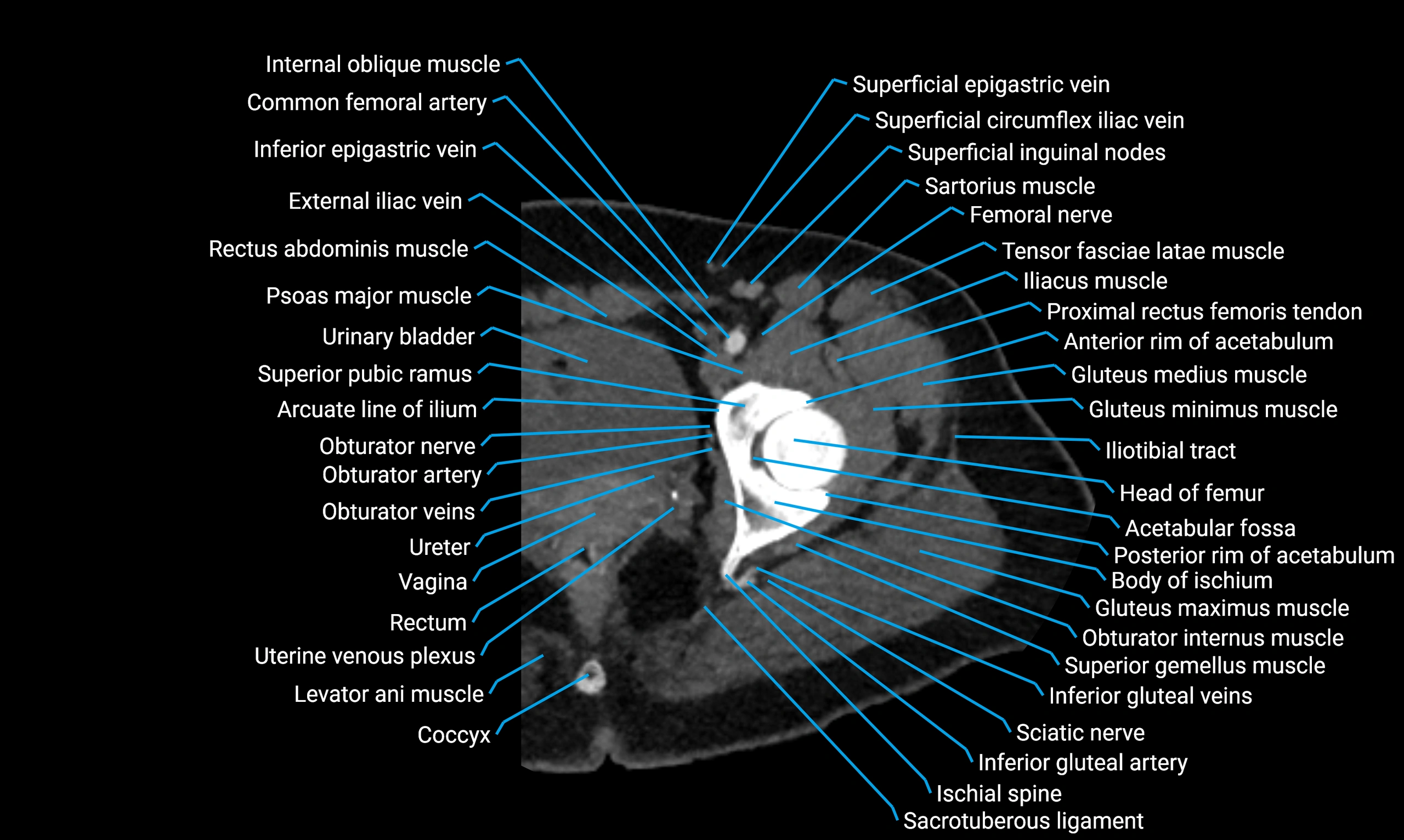CT thigh axial cross sectional anatomy labelled image_5 (1).webp